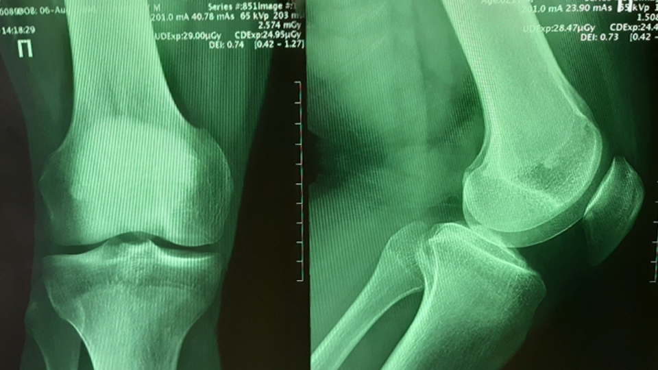 «Неизлечимость» износа суставов оказалась преувеличением